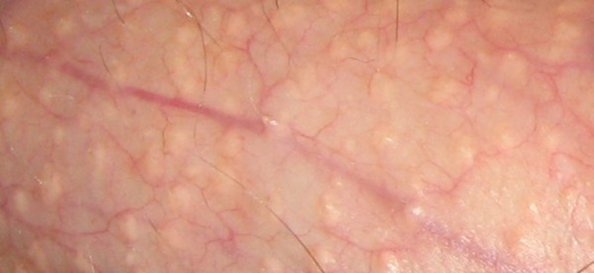 fordyce-spots.jpg