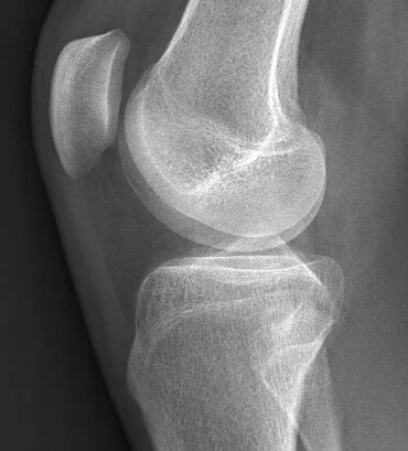 6665044_knee_3.webp