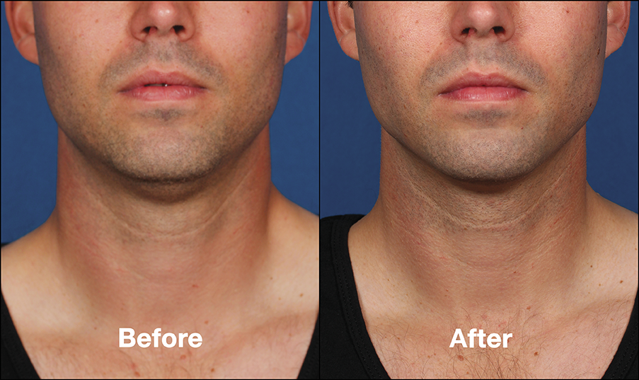 KybellaPatientPR2BeforeAfterFrontView.PNG