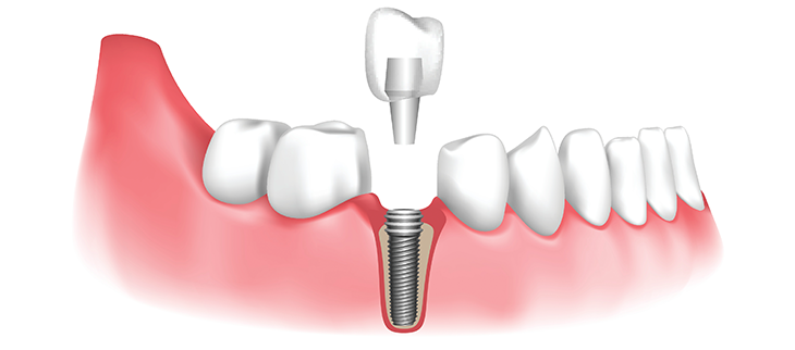 dental-implant.png