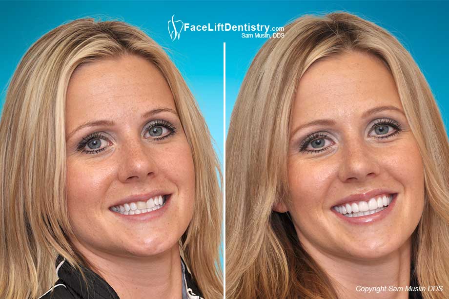 No-Prep Porcelain Veneers to Widen Smile