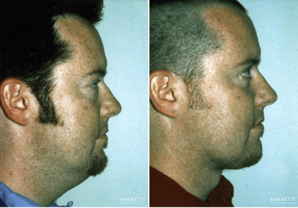 Necklift-Walnut-Creek-600x418-1.png