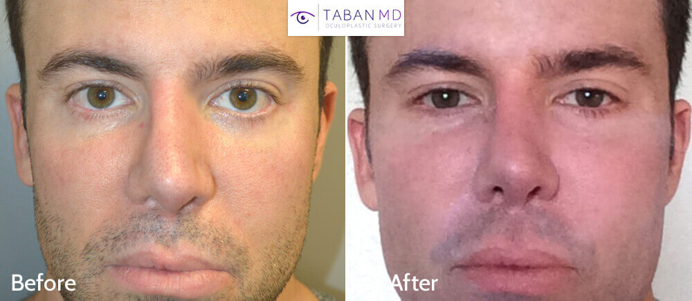 Young Caucasian man underwent infraorbital silicone implant plus lower eyelid retraction surgery with canthoplasty (