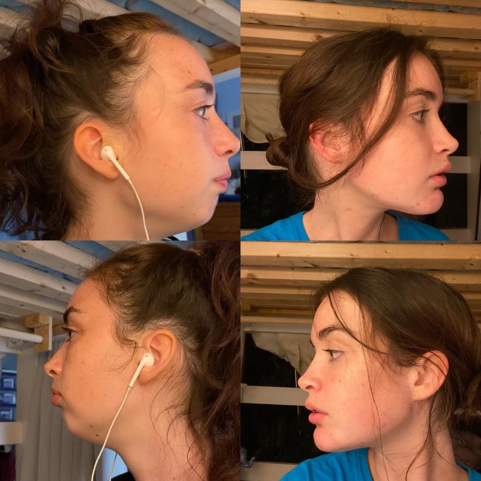 r/jawsurgery - Here’s my 5 month post op! DJS + genioplasty + septoplasty :) so happy w results