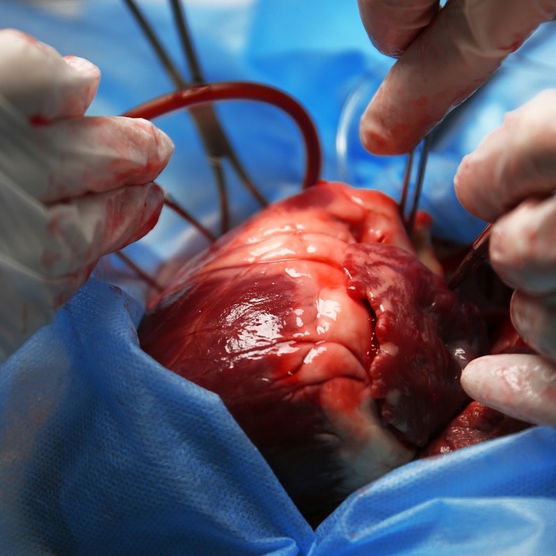 תוצאת תמונה עבור heart surgery