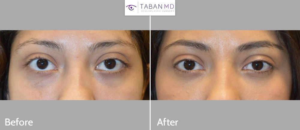 Young beautiful woman with genetic prominent bulging eyes underwent scarless cosmetic orbital decompression surgery. (She had initially tried temporary filler but later did this permanent surgery.)