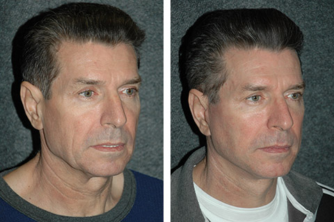best-male-facelift-results.jpg