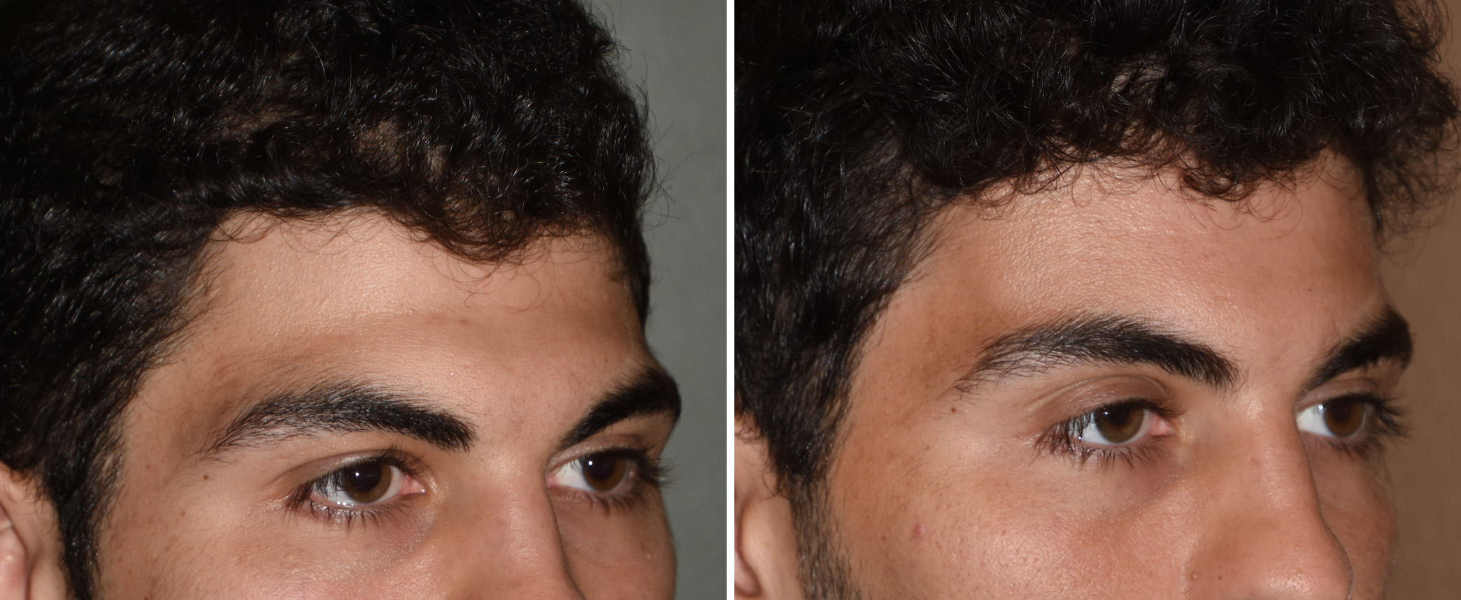 Forehead-Augmentation-result-oblique-view-Dr-Barry-Eppley-Indianapolis.jpg