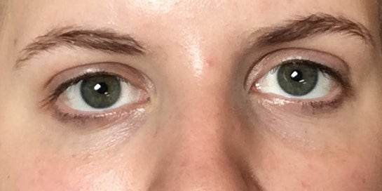 My obvious asymmetry with my eyes is driving me crazy, advice or  suggestions? (Photos)