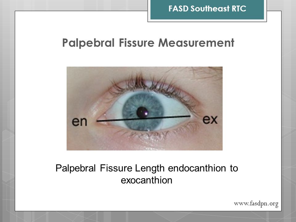 Palpebral+Fissure+Measurement.jpg