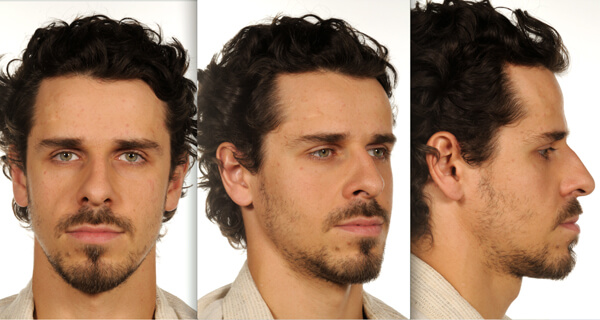 pmfaam20_mid-facial_implants_figures-2a.jpg