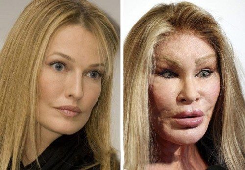 plastic-surgery-gone-wrong-12.jpg