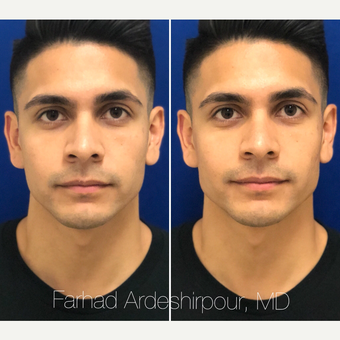Injectable-Fillers-before-7646271-3705843.jpeg
