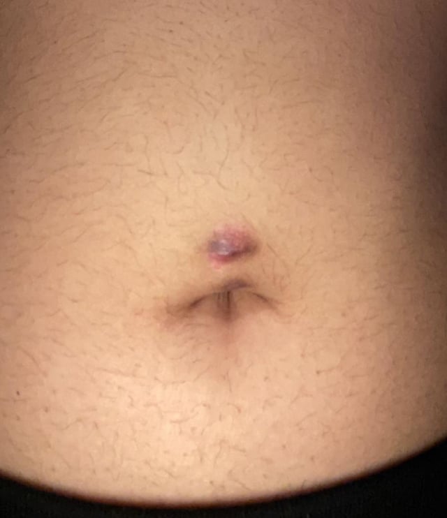 how-do-i-get-rid-of-a-bellybutton-scar-darkness-my-belly-v0-bozx91s7i5p81.jpg