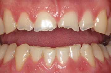 img-broken-tooth.jpg