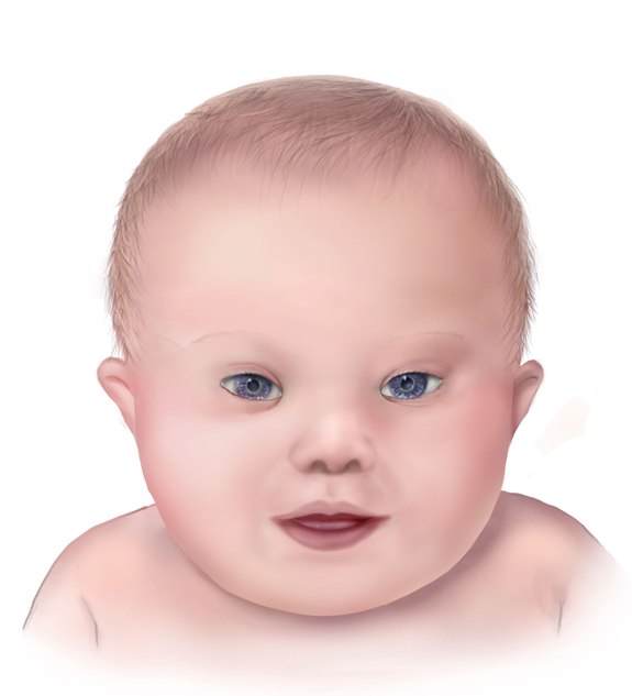 Down_syndrome_lg.jpg