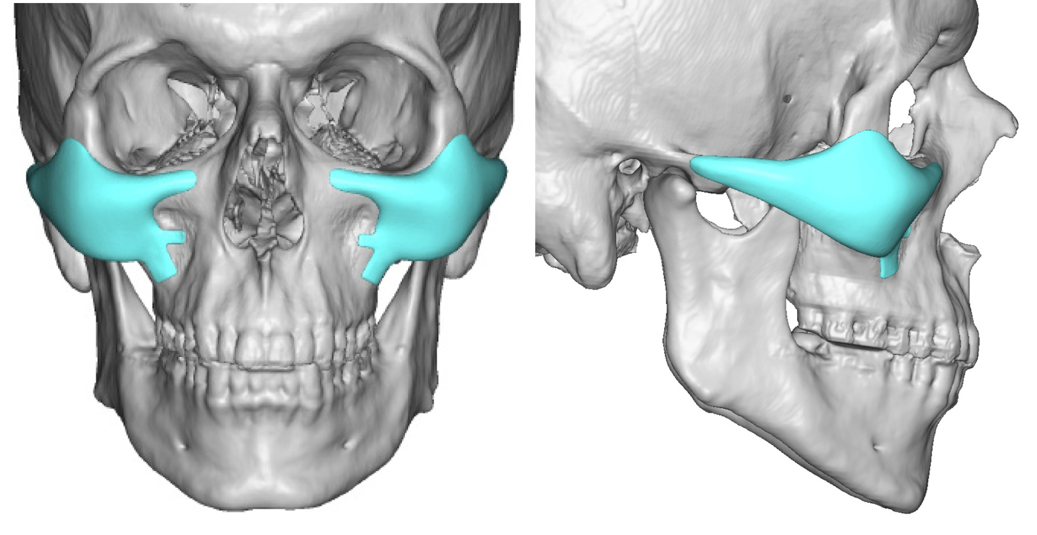 Custom-Cheek-Implants-with-tabs-Dr-Barry-Eppley-Indianapolis.jpg