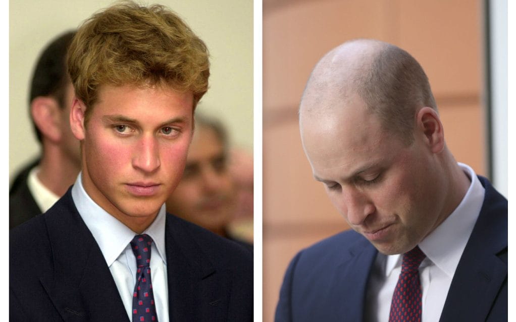 prince-william-before-and-after_trans_NvBQzQNjv4BqvpMwRrRx9VQUm62Rw6qRn8bLsPm_aUdQ6Nm2iQ9WcLU.jpg