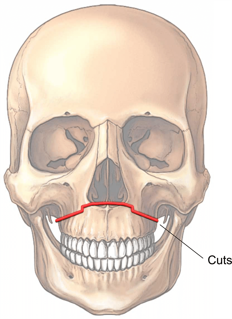 maxillary-le-fort-illustration-92a268.png