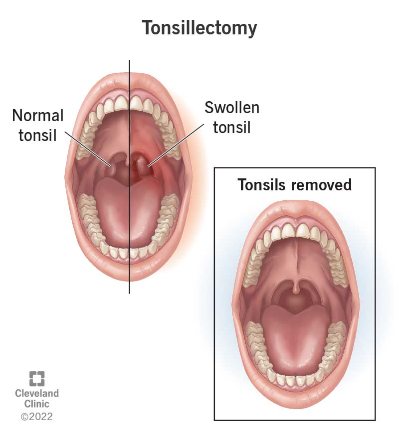 15605-tonsillectomy