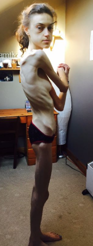 Anorexia Nervosa: What causes people to become anorexic? - Quora