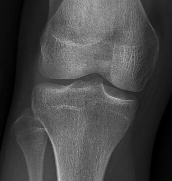 6665042_knee_1.webp