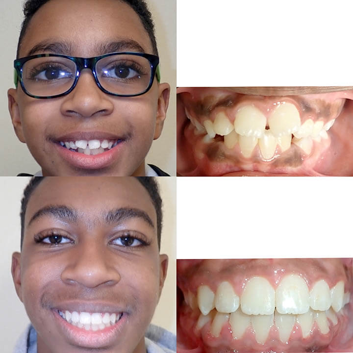 Before & After Braces | Wazio Orthodontics
