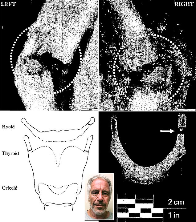 Jeffrey Epstein's autopsy report summary is released with pictures showing his bone