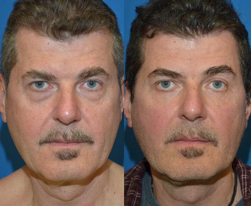 Facial Fat Grafting Bellevue & Seattle | Sam Naficy, MD, FACS