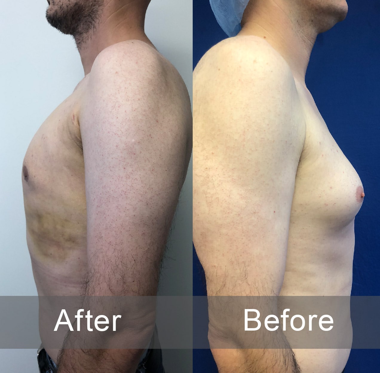 Alex-Before-After-min.jpg