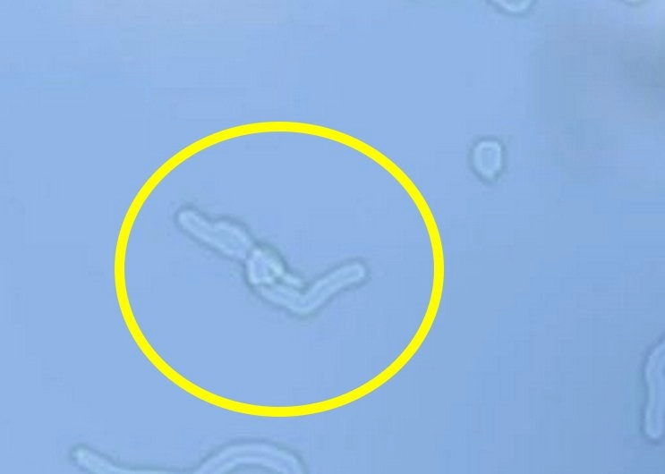 What Causes Eye Floaters? - WOOLF EYE LAB