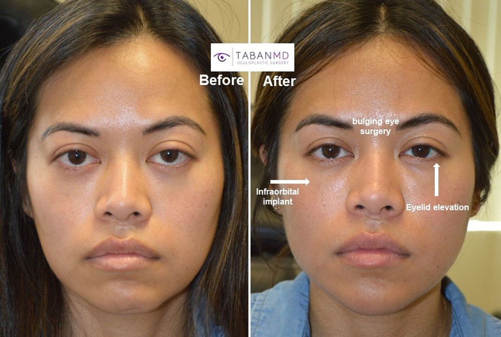 Customized Infraorbital Rim Implant Beverly Hills | Tear Trough Implant