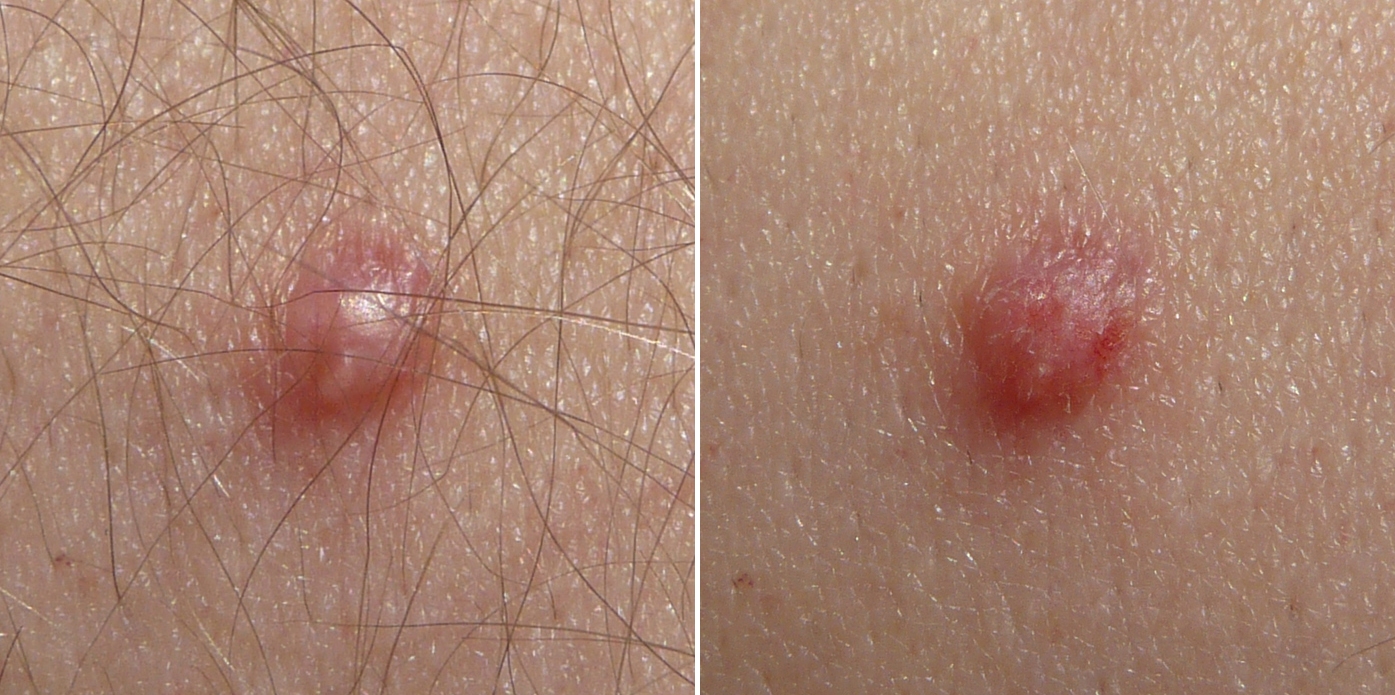 Papilloma.jpg