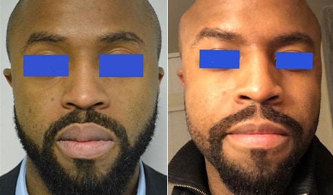 Hall_Boston_Lip-Reduction-1-AP.jpg