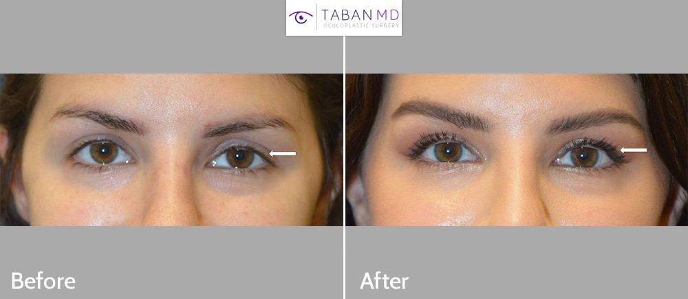 Beverly Hills Eye Asymmetry Surgery and Treatment | Dr. Mehryar Taban