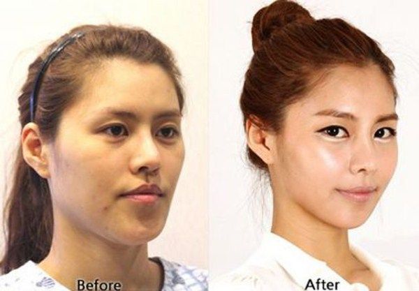 Young Koreans Before and After Plastic Surgery (62 photos ...