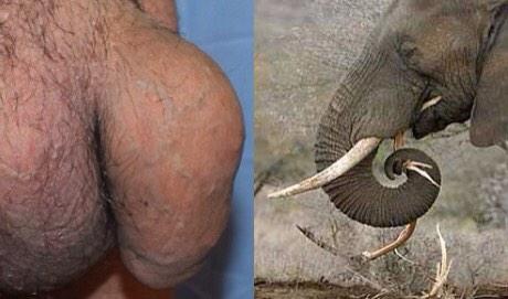 Image result for penis pmma injection complication