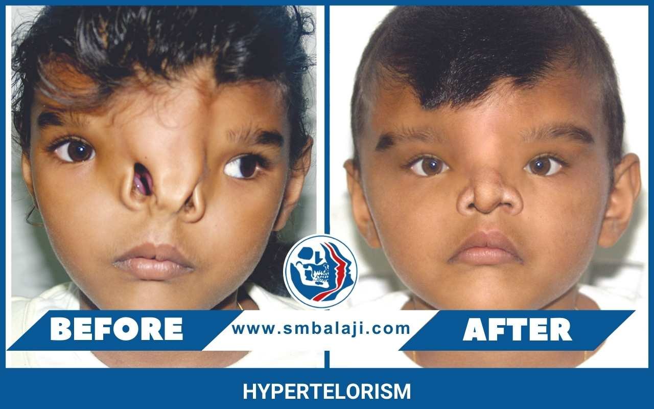 Hypertelorism-.jpg