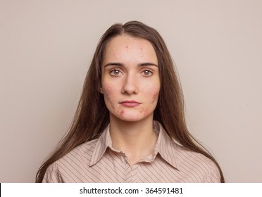 girl-acne-on-face-problem-260nw-364591481.jpg
