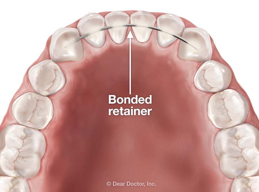 bonded-retainer.jpg
