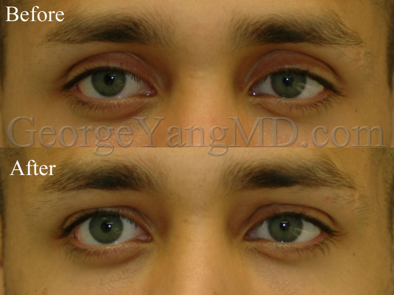Upper-eyelid-filler-BA-001WM-copy-1.jpg