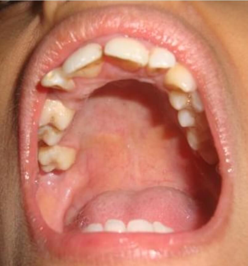 What is High-arched palate or Gothic palate? | News | Dentagama