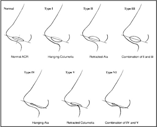 Columella-anatomy-Dr-Roth.jpg