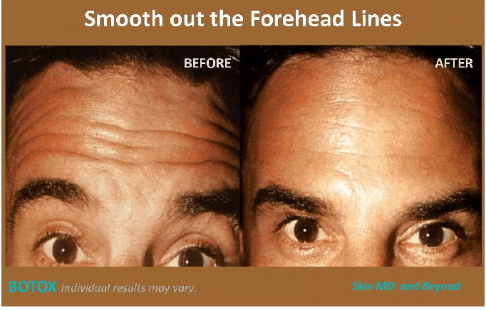 botox-dysport1.png