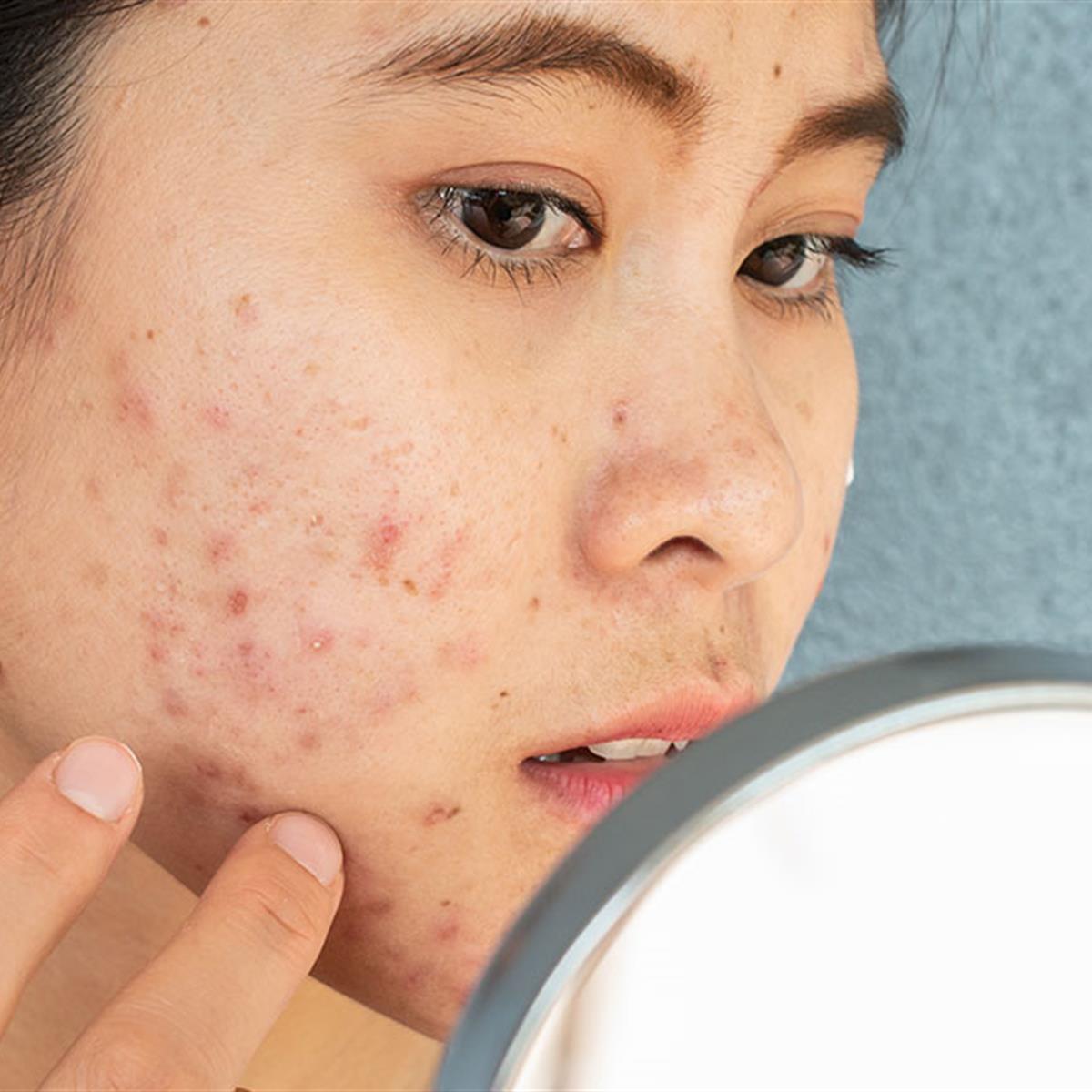 what-causes-acne.jpg