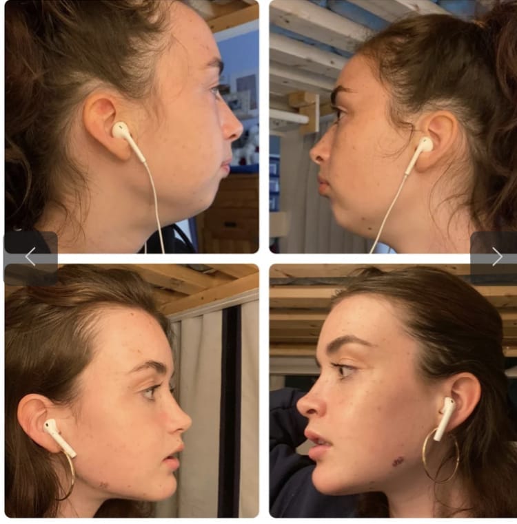 2312852_Example_of_Good_Jaw_Surgery_Result.jpeg