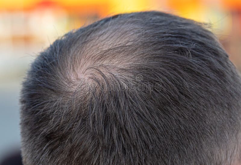 close-up-bald-spot-man-s-head-disease-220974140.jpg