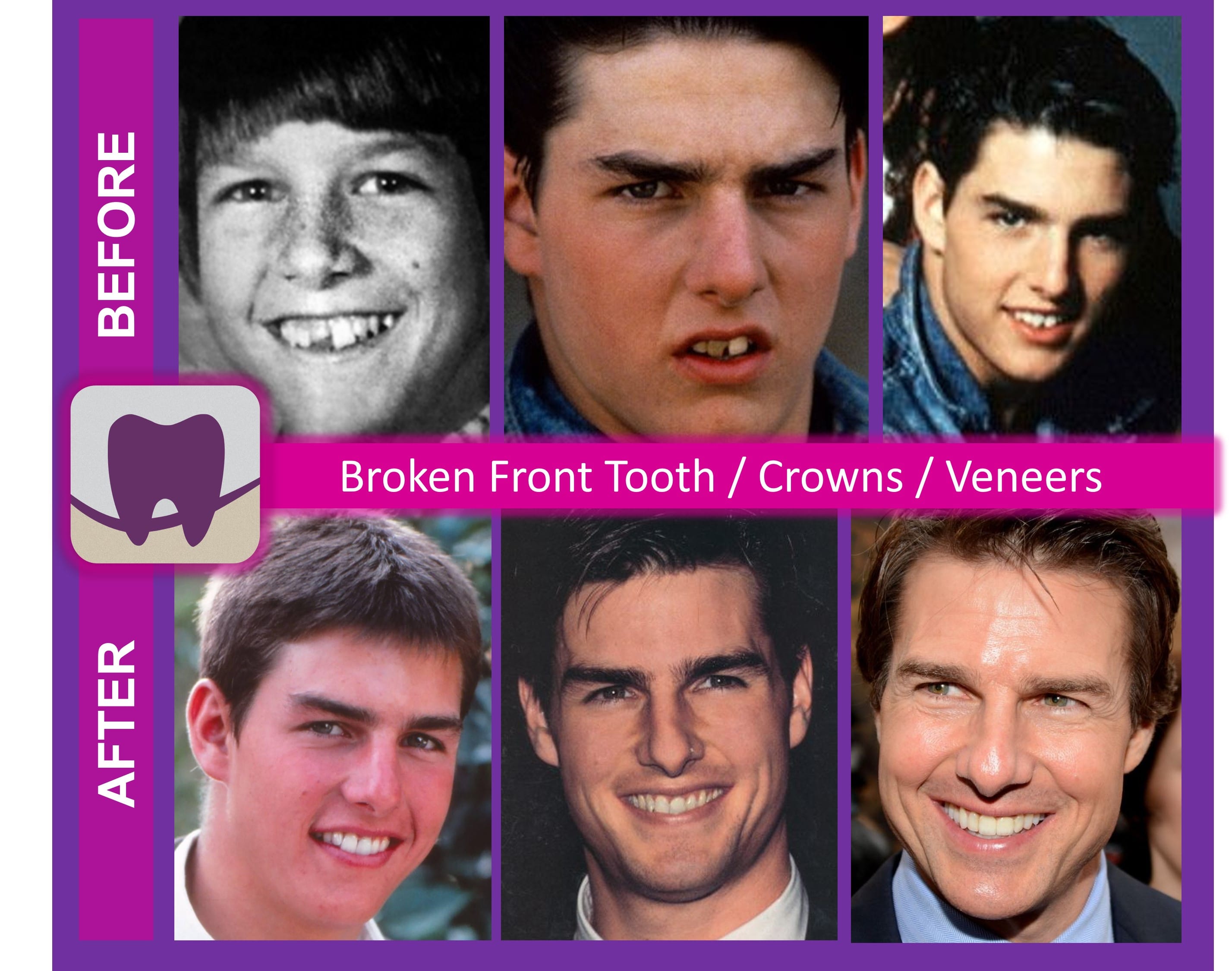 Tom Cruise Before and After – Stouffville SMILES Dentistry