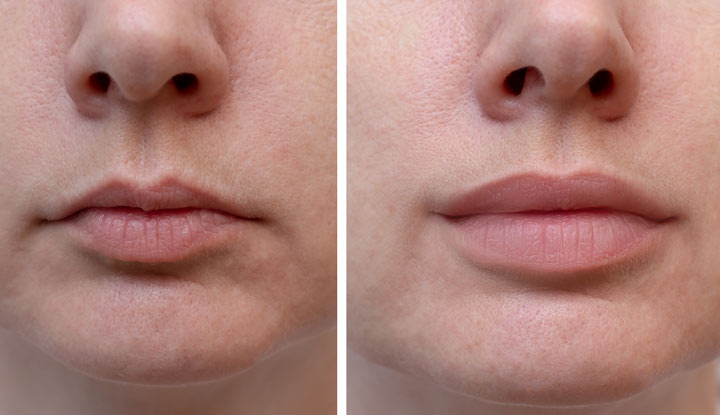 22133-lip-fillers-1177813558