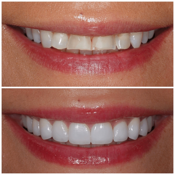 veneers-front.png